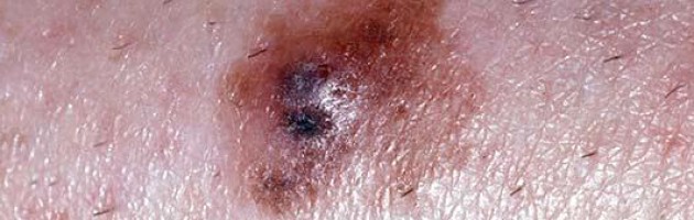 rak skóry czerniak usuwanie laserem